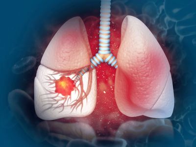 Lung Cancer Treatment In UK