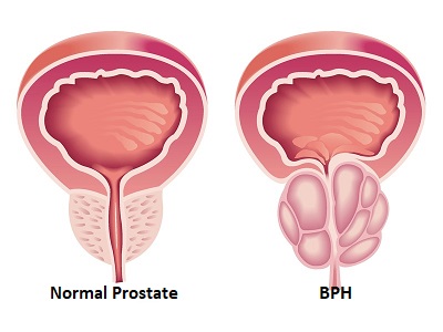 Prostate Cancer Treatment In UK