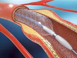 Angioplasty Surgery In Asia